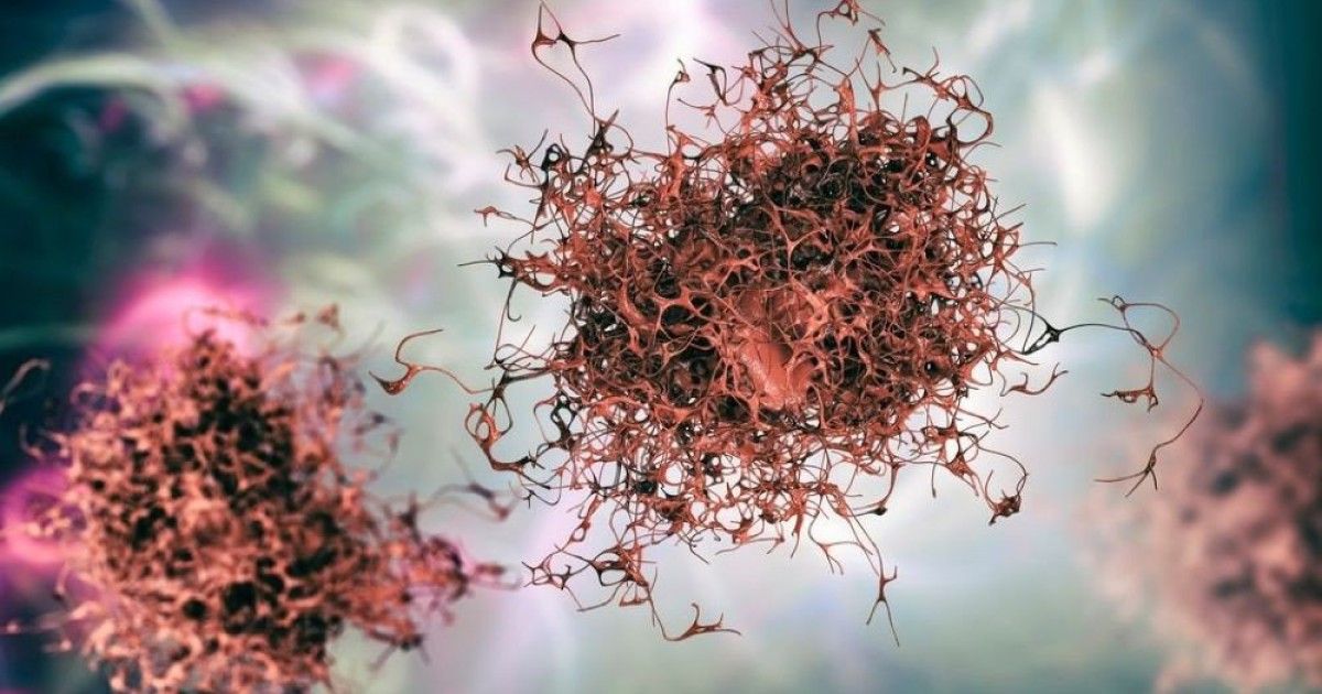 ai-pancreatic-cancer-diagnosis.jpg