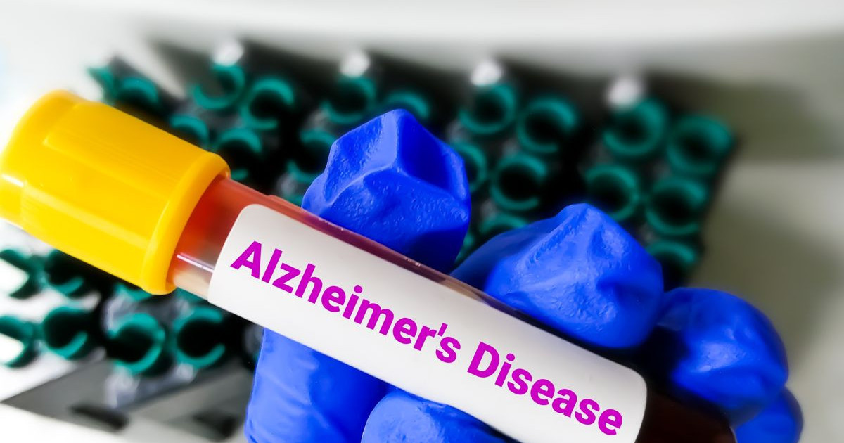 alzheimers-disease-blood-test.jpg