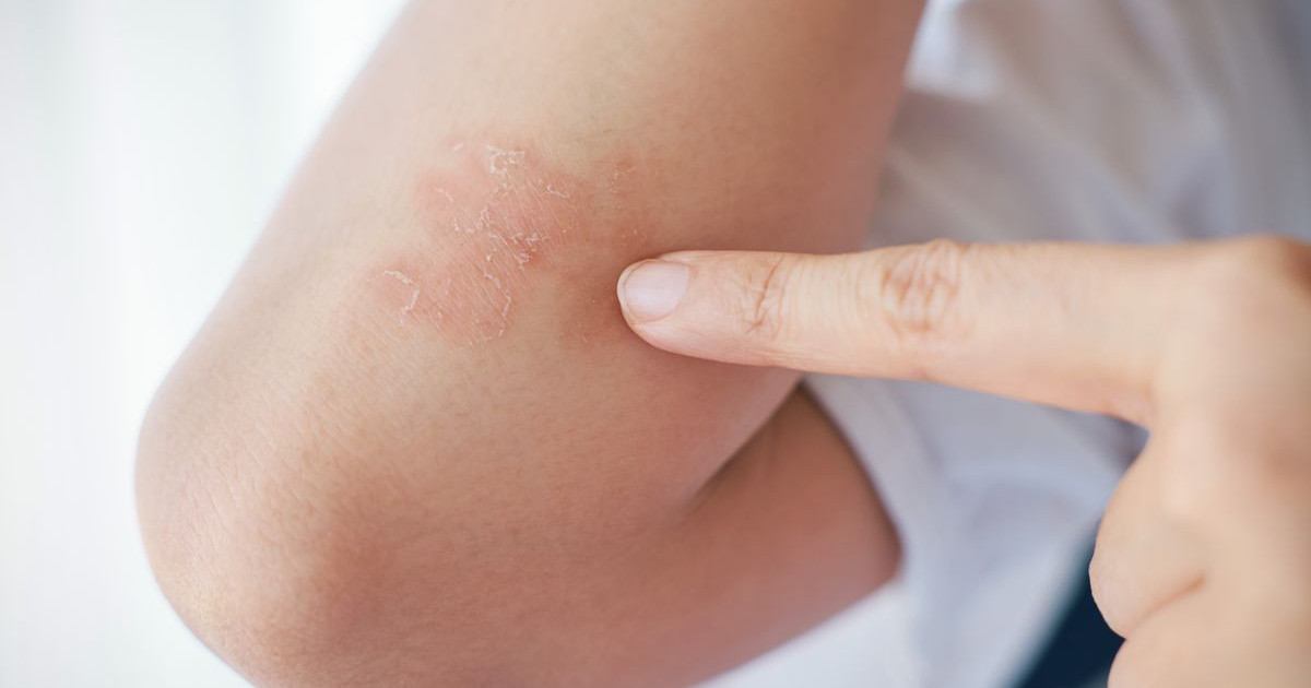 psoriasis.jpg