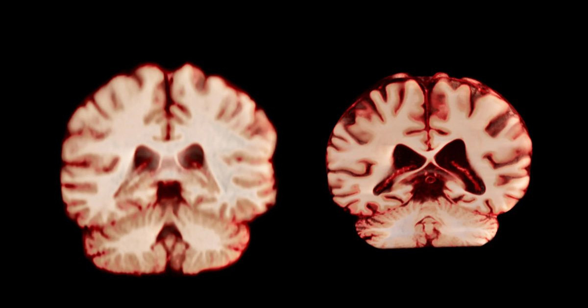 health-brain-vs-alzheimers.jpg