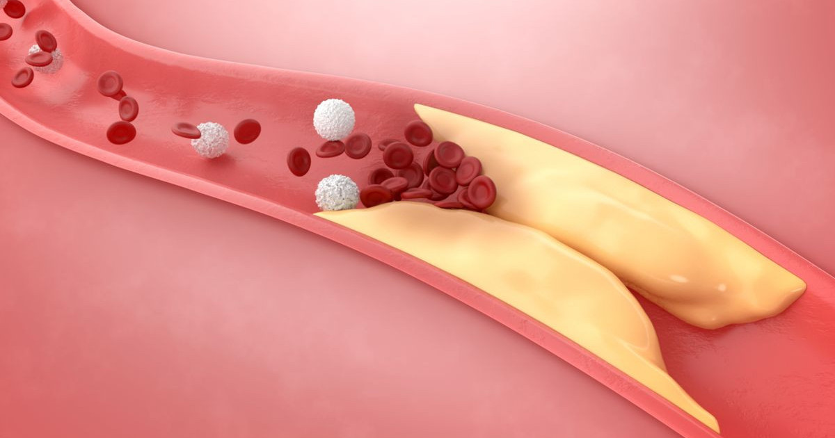 cholesterol-therapy.jpg