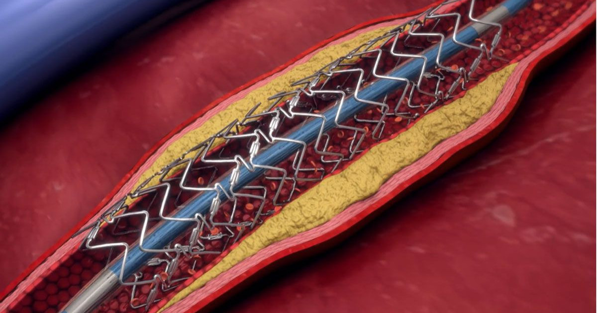 ai-coronary-angioplasty.jpg
