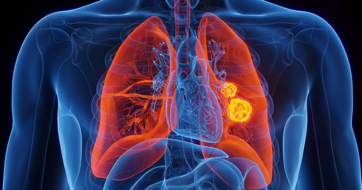dna-mutation-lung-cancer-non-smokers.jpg