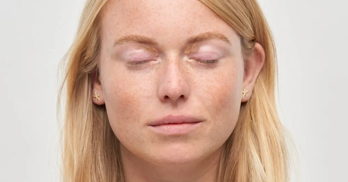 xanthelasma-1.jpg